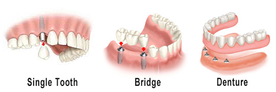 Dental Implants, Dentures, Bridges Los Angeles, CA